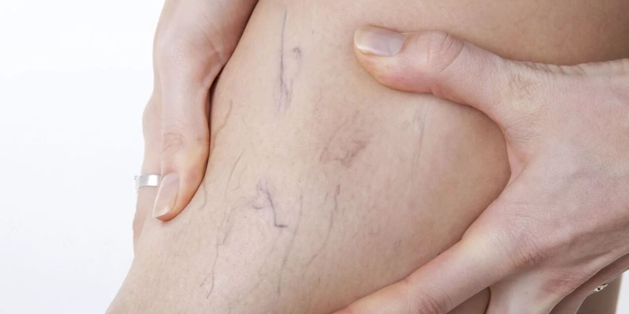 Antes do uso de creme varicone