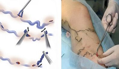 Flebectomy para varizes nas pernas