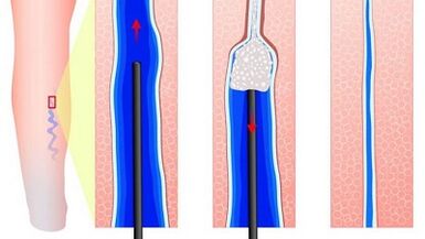 escleroterapia para varizes