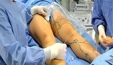 Operação para varizes veias
