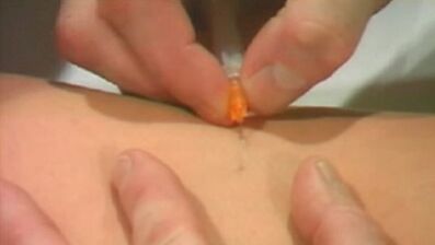 Métodos de varizes veias das extremidades inferiores